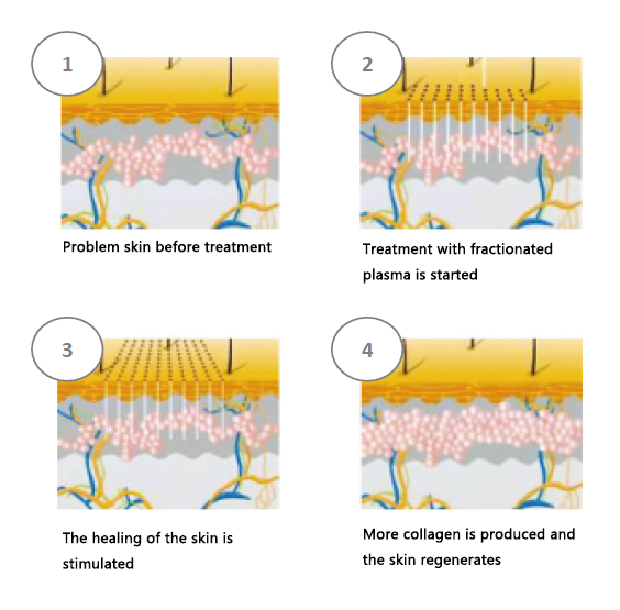 Plasma Frax Treatment in The Woodlands, TX | Naked SKN Aesthetics