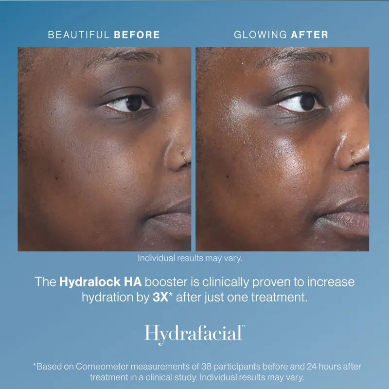 Before and after hydrafacial treatment gallery in The Woodlands, TX | Naked SKN Aesthetics
