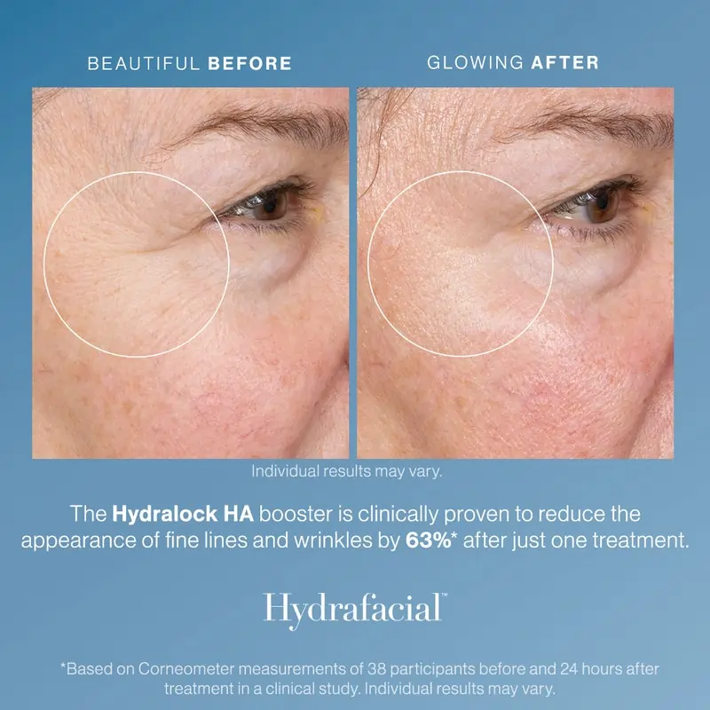 Before and after hydrafacial treatment gallery in The Woodlands, TX | Naked SKN Aesthetics