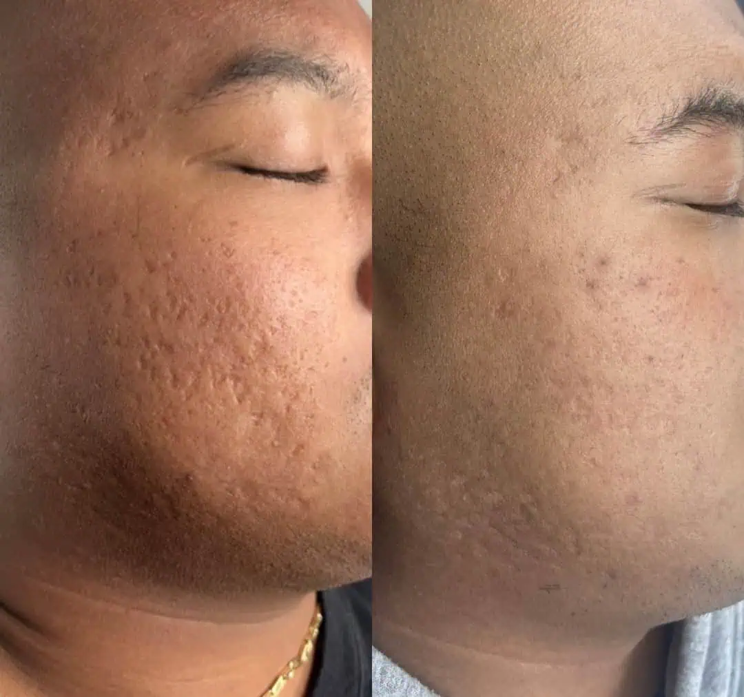 Aging Wrinkles Before And After in The Woodlands, TX | Naked SKN in The Woodlands, TX