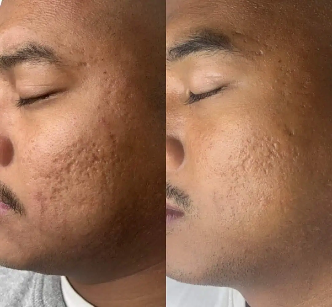 Aging Wrinkles Before And After in The Woodlands, TX | Naked SKN in The Woodlands, TX