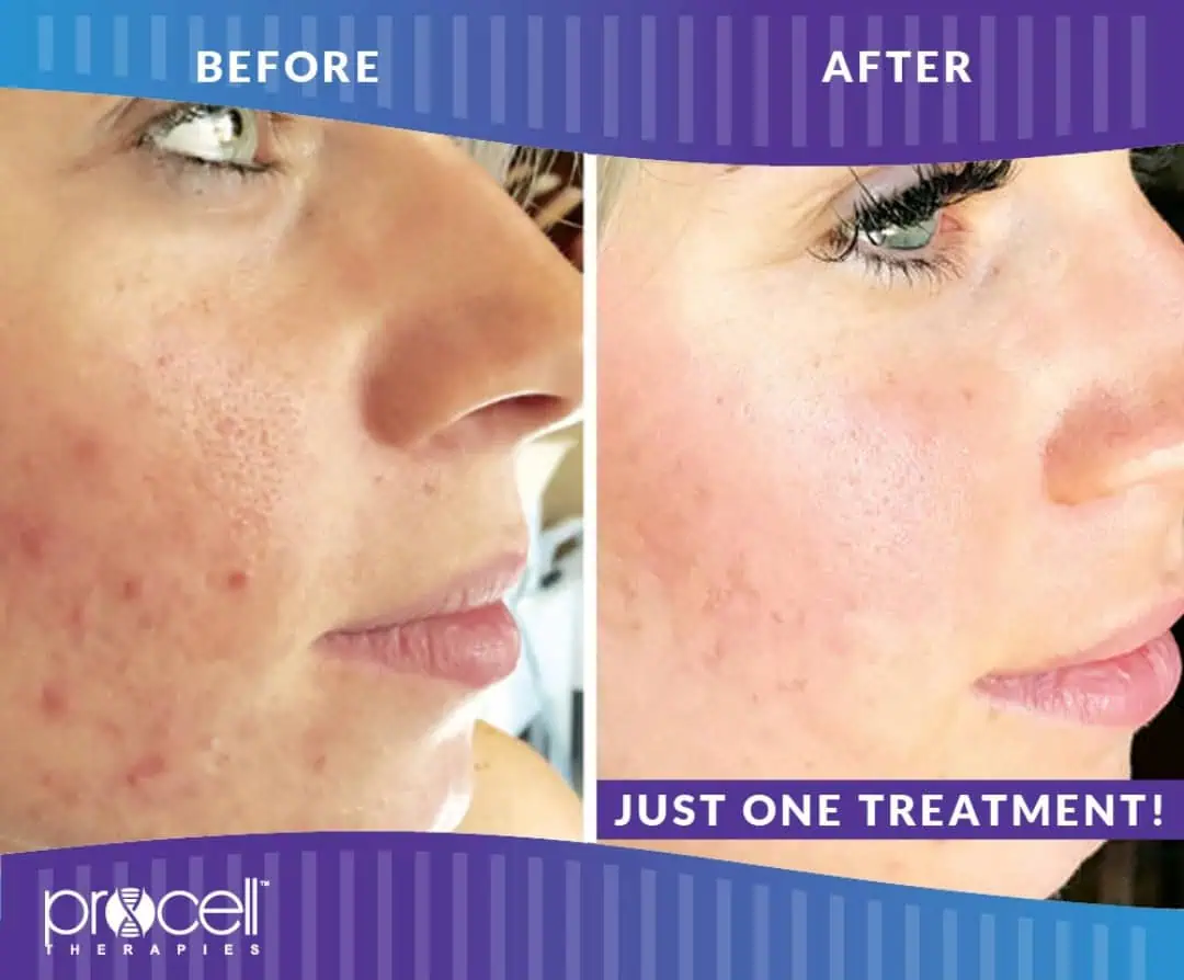 Before and after treatment gallery in The Woodlands, TX | Naked SKN Aesthetics