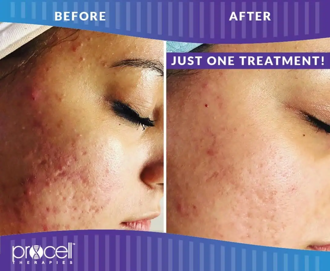 Before and after treatment gallery in The Woodlands, TX | Naked SKN Aesthetics
