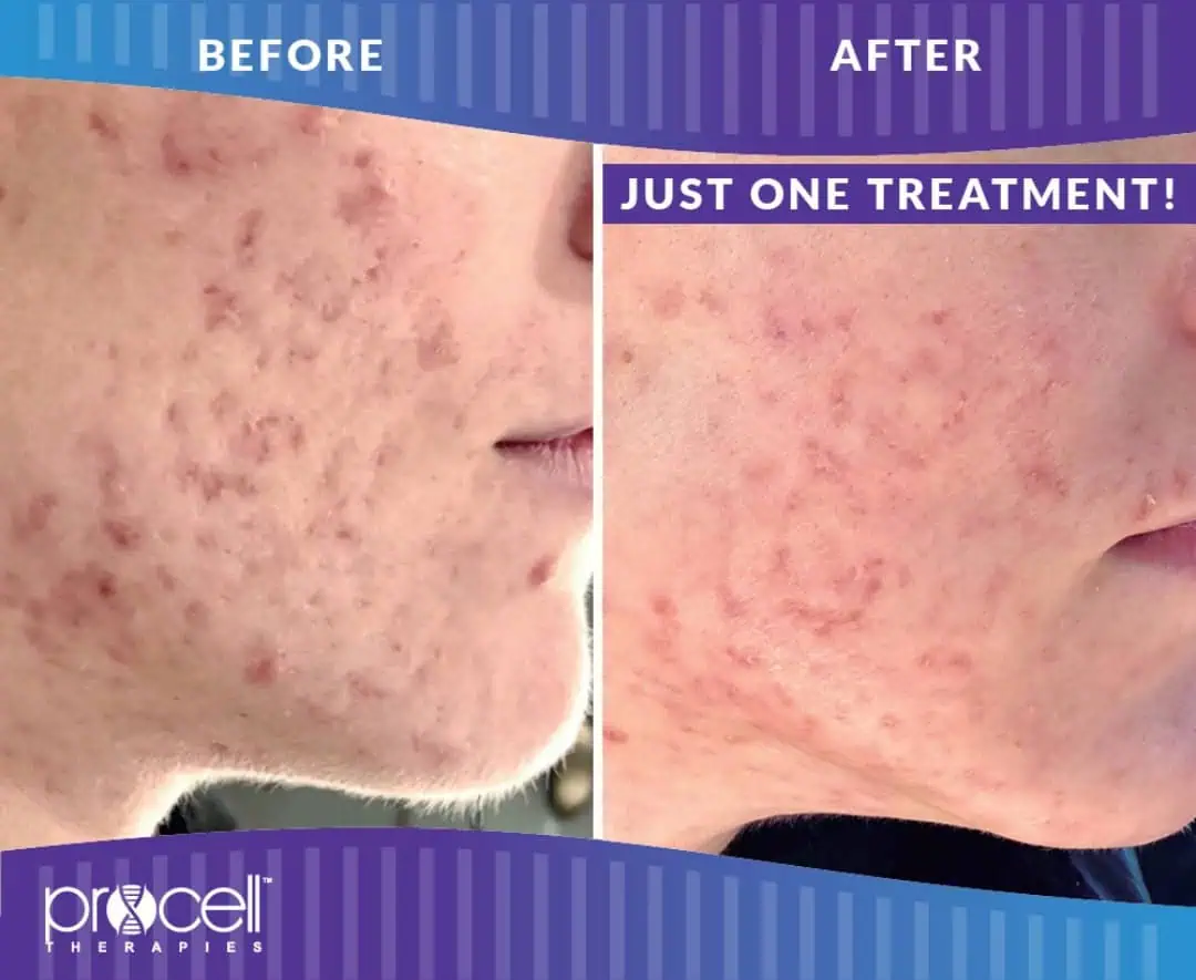 Before and after treatment gallery in The Woodlands, TX | Naked SKN Aesthetics