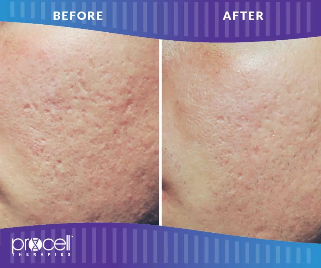 Before and after treatment gallery in The Woodlands, TX | Naked SKN Aesthetics