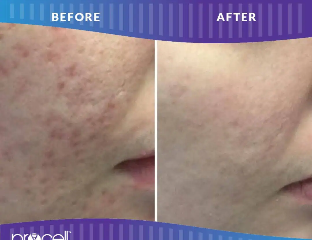 Before and after treatment gallery in The Woodlands, TX | Naked SKN Aesthetics