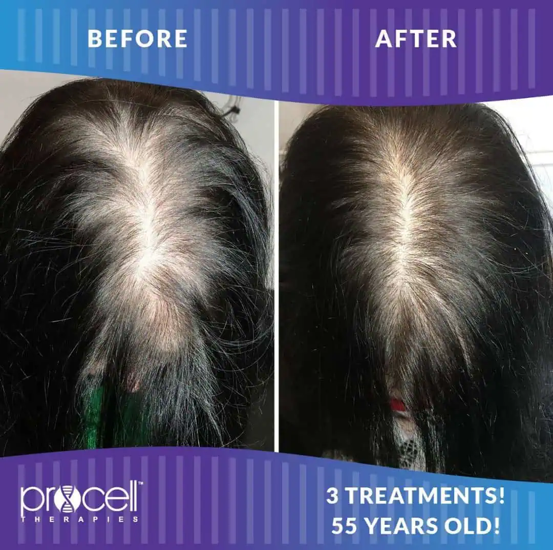 Hair Treatment Before And After in The Woodlands, TX | Naked SKN in The Woodlands, TX