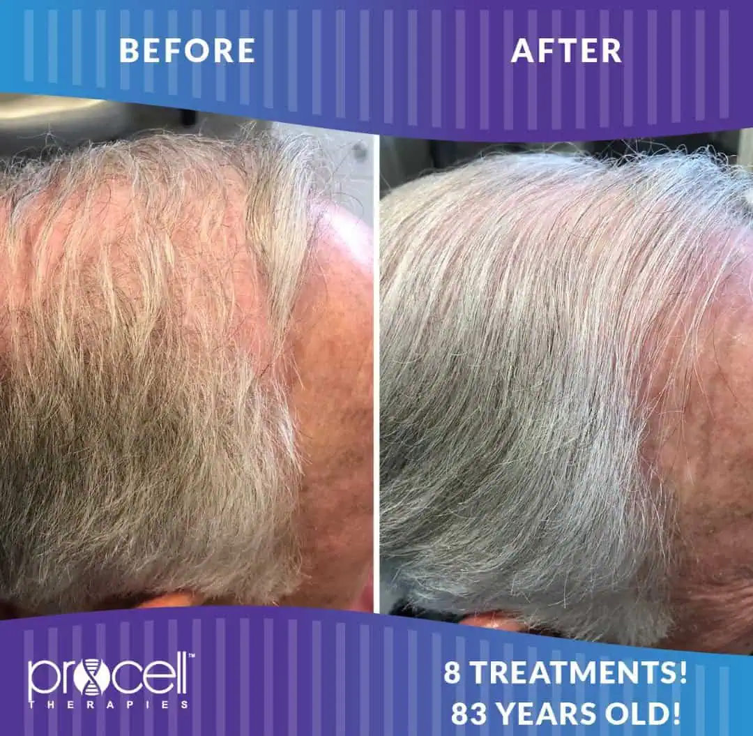Hair Treatment Before And After in The Woodlands, TX | Naked SKN in The Woodlands, TX