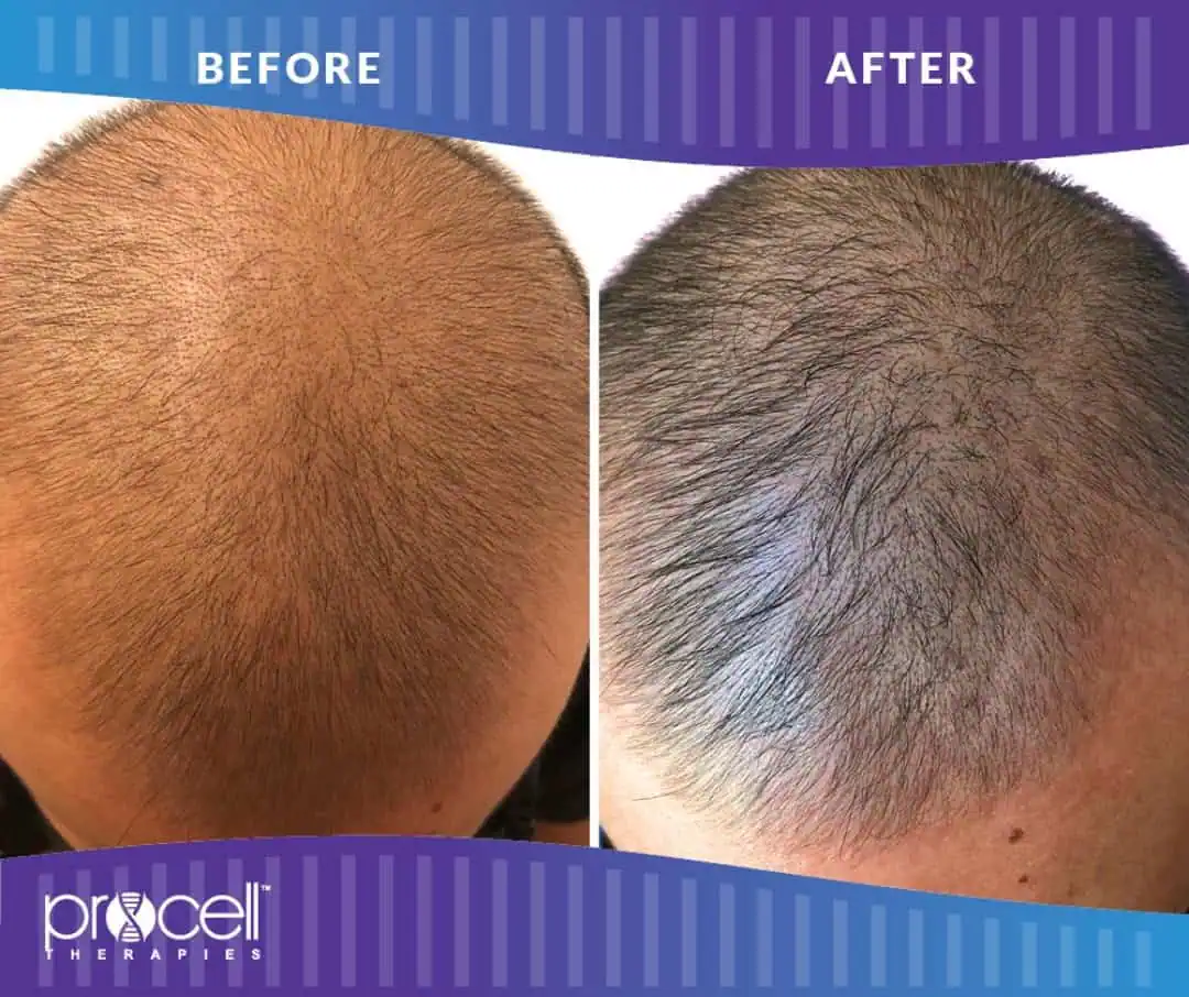 Before and after Hair Treatment in The Woodlands, TX | Naked SKN Aesthetics