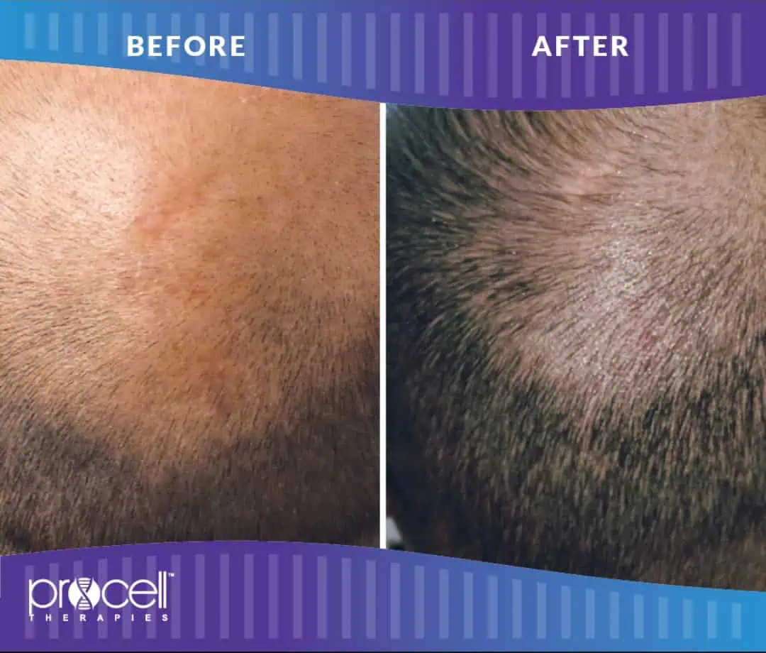 Before and after Hair Treatment in The Woodlands, TX | Naked SKN Aesthetics