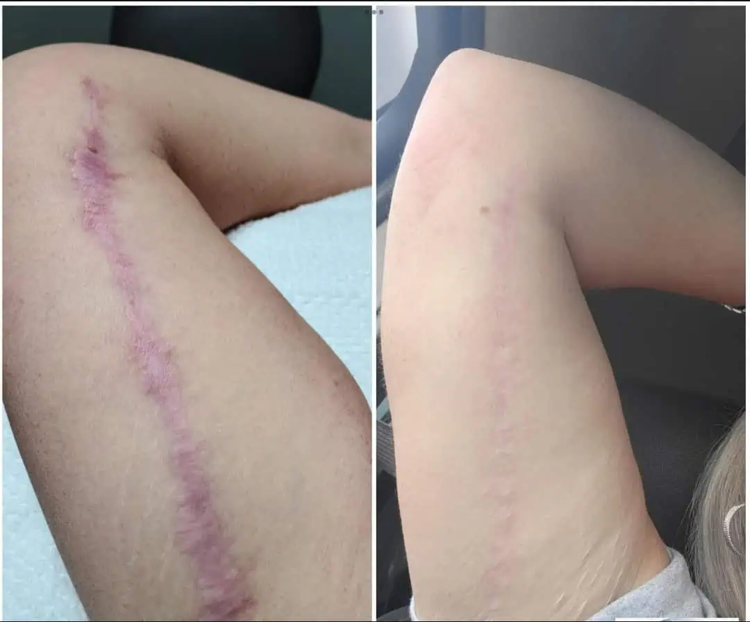 Wrinkles Before And After in The Woodlands, TX | Naked SKN in The Woodlands, TX