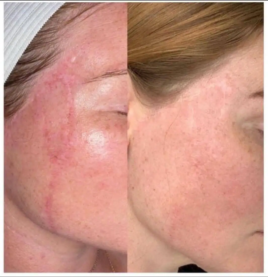 Aging Wrinkles Before And After in The Woodlands, TX | Naked SKN in The Woodlands, TX