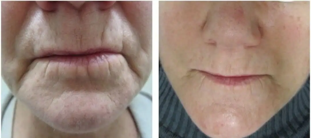 Wrinkles Before And After in The Woodlands, TX | Naked SKN in The Woodlands, TX