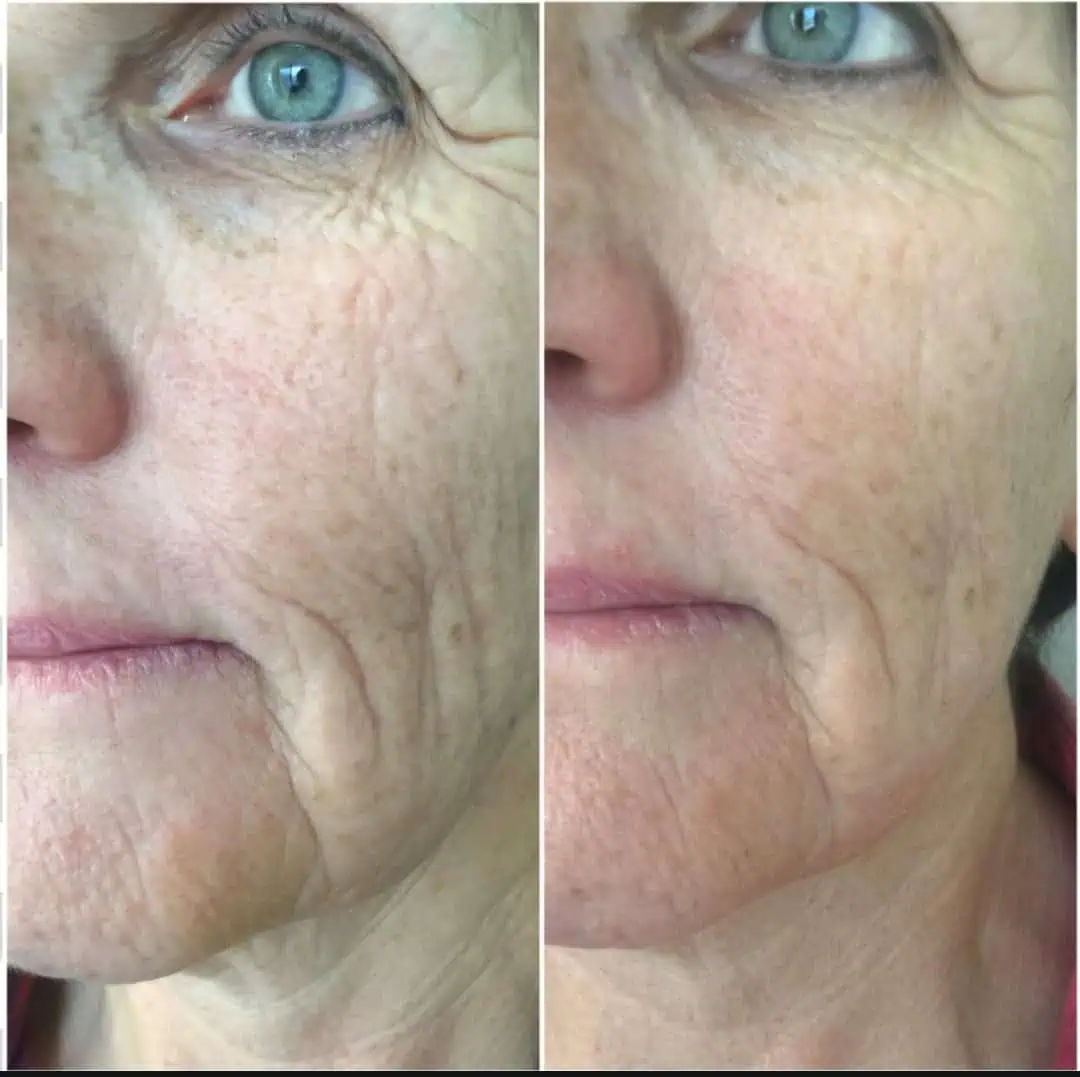 Aging Wrinkles Before And After in The Woodlands, TX | Naked SKN in The Woodlands, TX