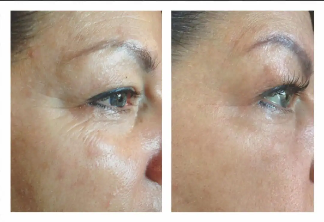 Aging Wrinkles Before And After in The Woodlands, TX | Naked SKN in The Woodlands, TX