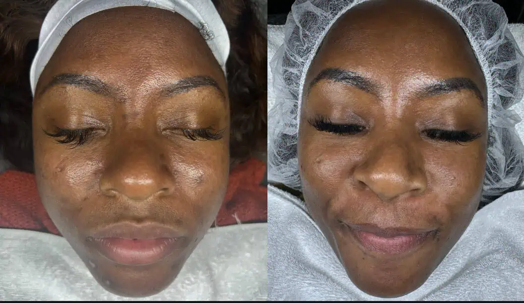 Aging Wrinkles Before And After in The Woodlands, TX | Naked SKN in The Woodlands, TX