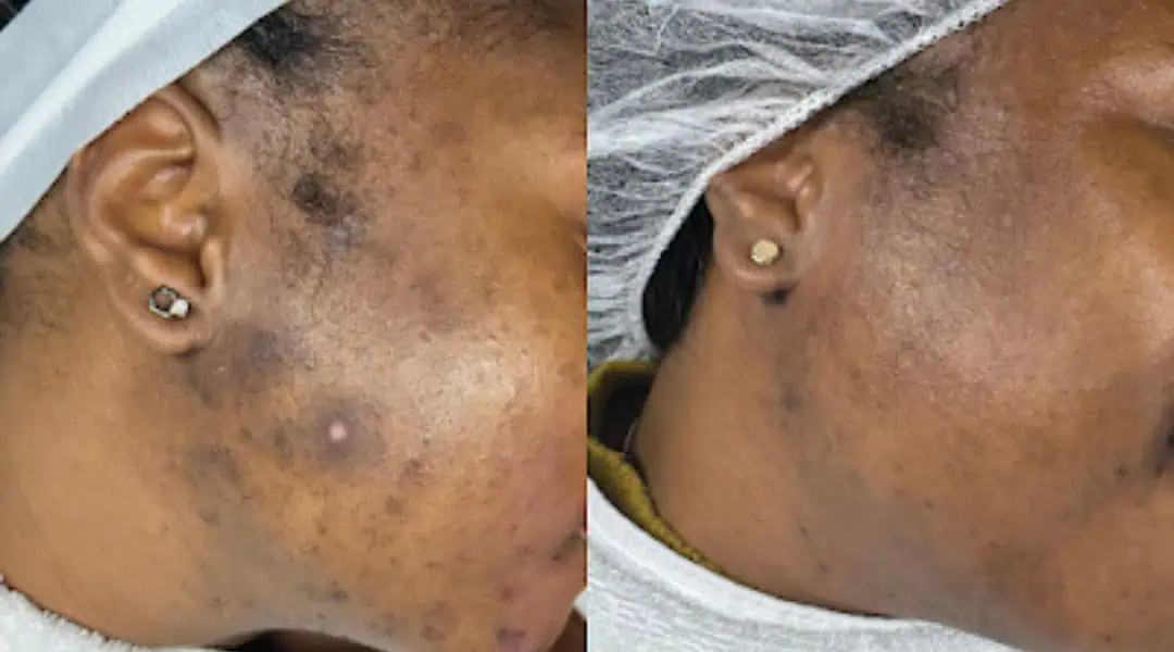 Aging Wrinkles Before And After in The Woodlands, TX | Naked SKN in The Woodlands, TX