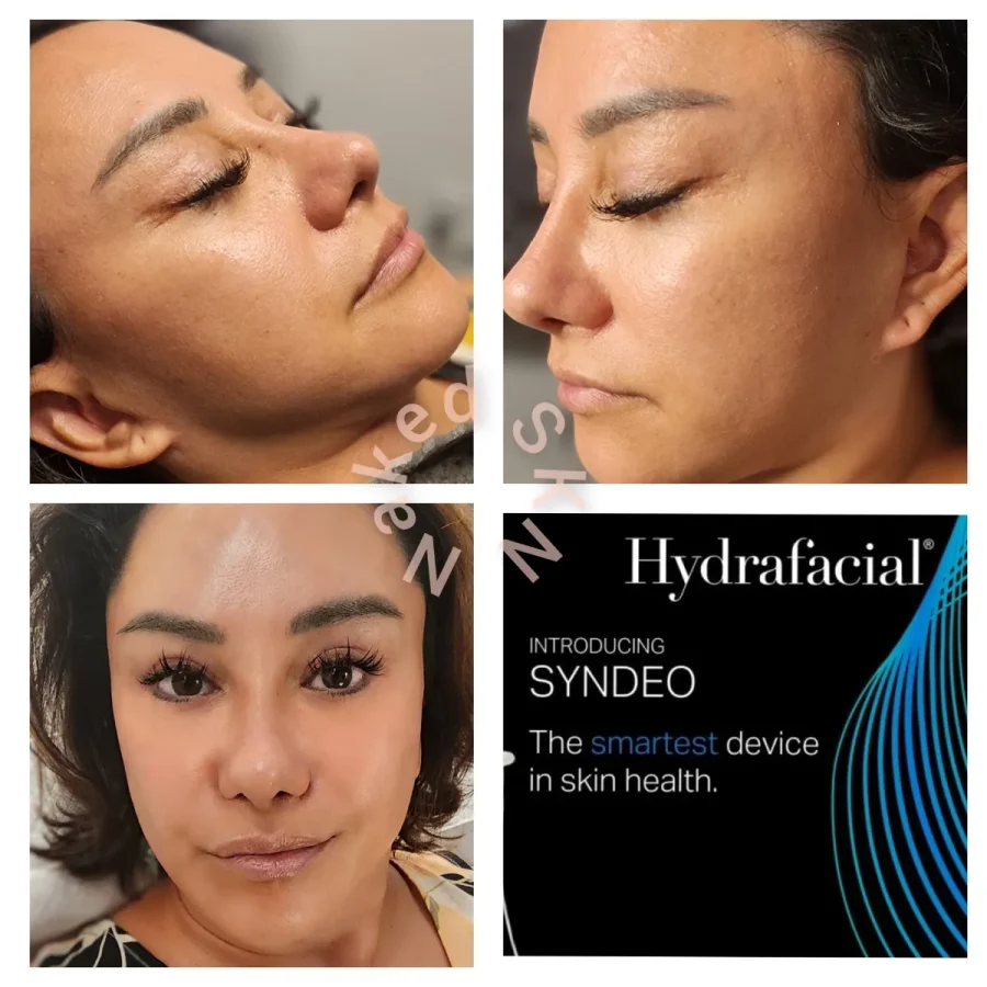 Hydrafacial Treatment Gallery in The Woodlands, TX | Naked SKN in The Woodlands, TX Hydrafacial Treatment Gallery in The Woodlands, TX | Naked SKN in The Woodlands, TX